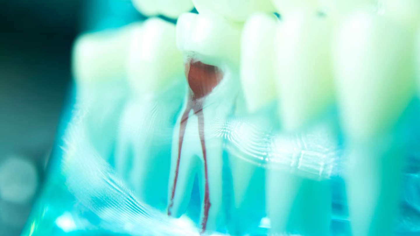 Close-up Of Root Canal